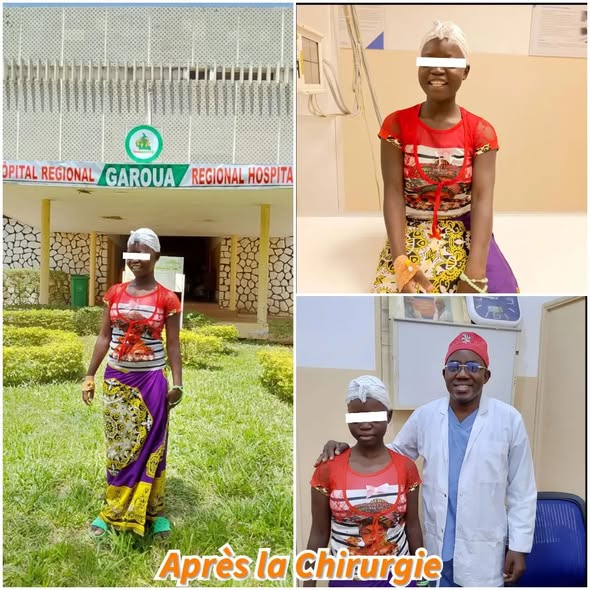 Successful Total Resection of Giant Brain Tumor by Garoua Regional Hospital Neurosurgical Team